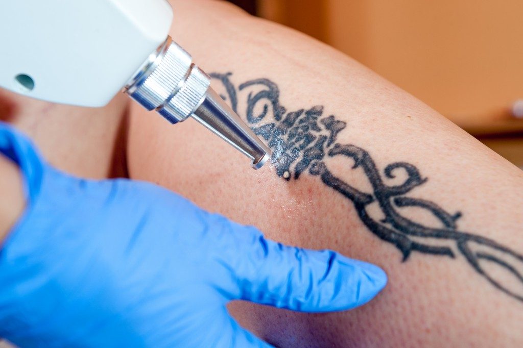 laser tattoo removal