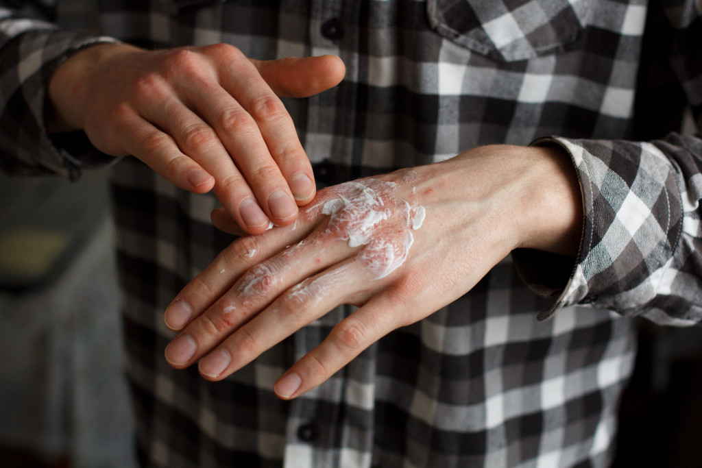 A man applying skincare to treat psoriasis