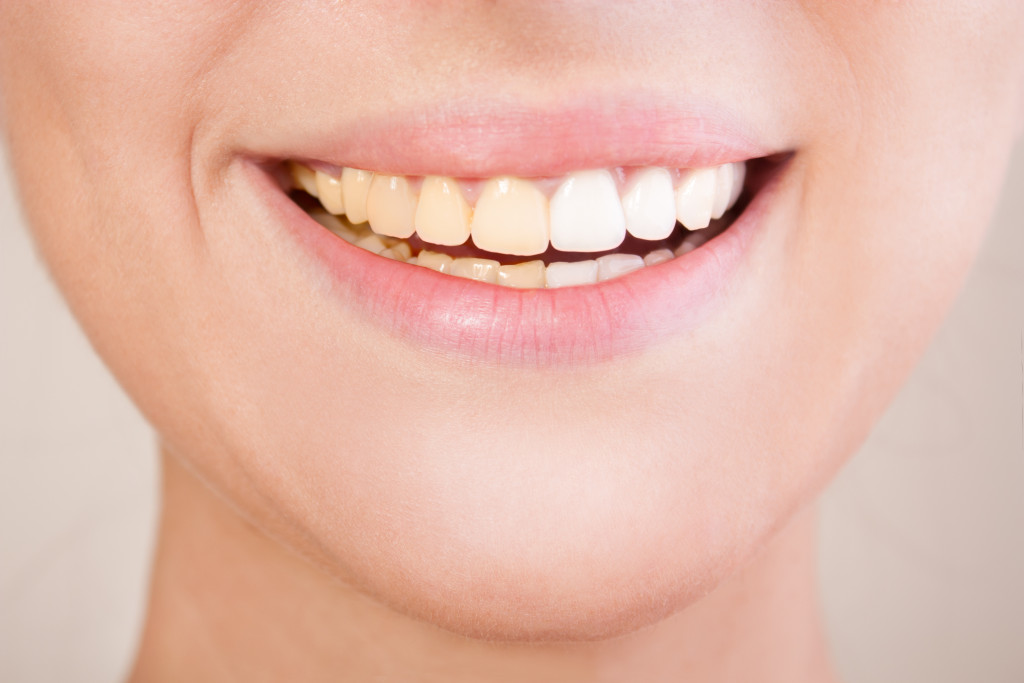 Closeup of a smile showing teeth